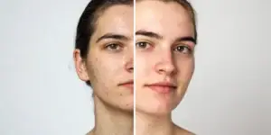 Before and after a chemical peel for acne scars, showing smoother skin texture and faded marks.